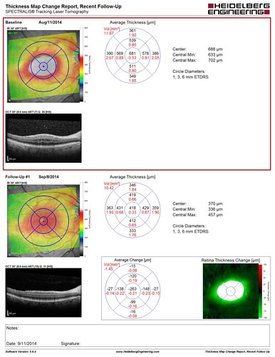 Cystoid Macular Edema following Cataract surgery and vitrectomy for floaters
73 year old woman who had decreased vision 4 months following combined vitrectomy and cataract surgery.  VA 20/63 improved in 1 month to 20/25 with ketorolac and prednisolone drops.
