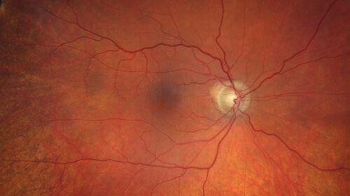 Macular edema from latanaprost
79 year old man with macula off RD repair 15 years ago and cataract surgery 14 years ago with new CME.  Patient recently started on latanaprost  VA 20/100 OD
