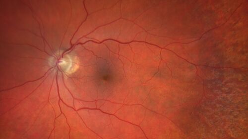 Macular edema from latanaprost
79 year old man with macula off RD repair 15 years ago and cataract surgery 14 years ago with new CME.  Patient recently started on latanaprost  VA 20/100 OD
