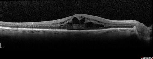 Macular edema from latanaprost
79 year old man with macula off RD repair 15 years ago and cataract surgery 14 years ago with new CME.  Patient recently started on latanaprost  VA 20/100 OD
