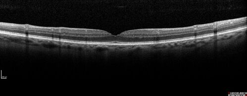 Macular edema from latanaprost
79 year old man with macula off RD repair 15 years ago and cataract surgery 14 years ago with new CME.  Patient recently started on latanaprost  VA 20/100 OD
