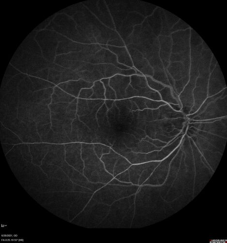 Macular edema from latanaprost
79 year old man with macula off RD repair 15 years ago and cataract surgery 14 years ago with new CME.  Patient recently started on latanaprost  VA 20/100 OD

