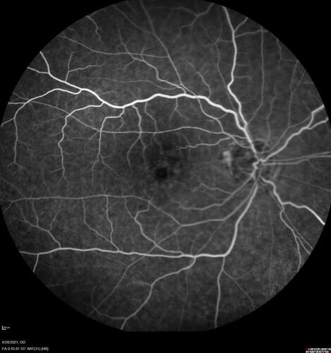 Macular edema from latanaprost
79 year old man with macula off RD repair 15 years ago and cataract surgery 14 years ago with new CME.  Patient recently started on latanaprost  VA 20/100 OD
