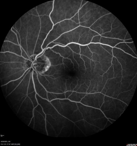 Macular edema from latanaprost
79 year old man with macula off RD repair 15 years ago and cataract surgery 14 years ago with new CME.  Patient recently started on latanaprost  VA 20/100 OD
