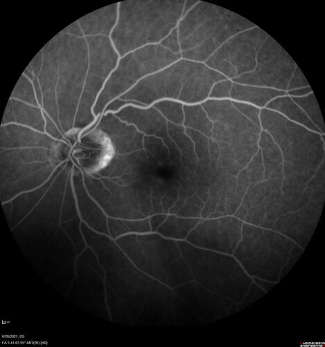 Macular edema from latanaprost
79 year old man with macula off RD repair 15 years ago and cataract surgery 14 years ago with new CME.  Patient recently started on latanaprost  VA 20/100 OD
