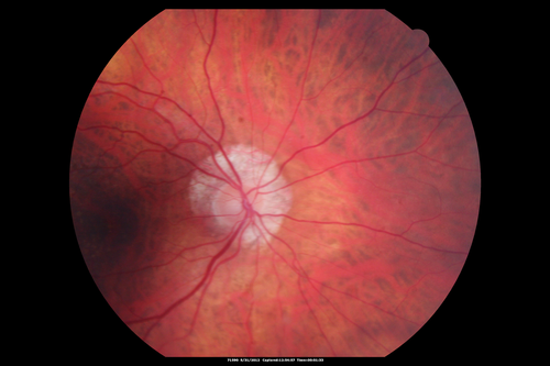 Lumigan (Bimatoprost) Cystoid Macular Edema - Eye Better 1 month after Stopping Lumigan
