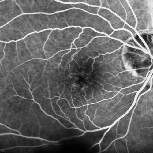  82-year-old man had cataract surgery in 1993.  He has had glaucoma for seven or eight years for a long time.  He is taking Lumigan only in the left eye.  About a year ago he started in the right eye and then starting just about a few months ago he has noticed intermittent blurring in the vision in the right eye. Vision 20/25 OD, 20/20 OS
