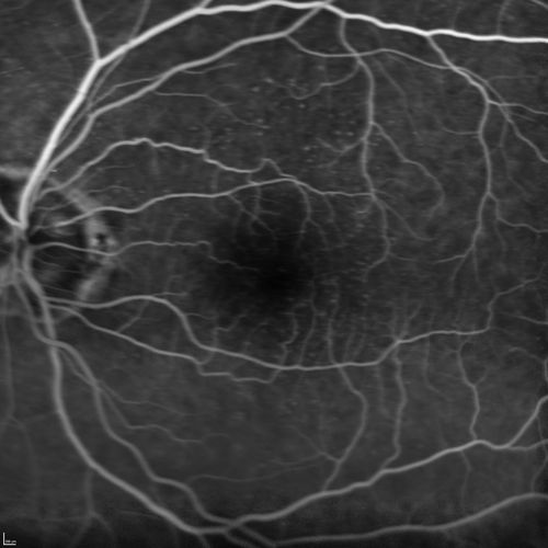 Lumigan (Bimatoprost) Cystoid Macular Edema - Eye Better 1 month after Stopping Lumigan
 82-year-old man had cataract surgery in 1993.  He has had glaucoma for seven or eight years for a long time.  He is taking Lumigan only in the left eye.  About a year ago he started in the right eye and then starting just about a few months ago he has noticed intermittent blurring in the vision in the right eye. Vision 20/25 OD, 20/20 OS
