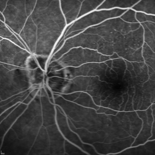 Lumigan (Bimatoprost) Cystoid Macular Edema - Eye Better 1 month after Stopping Lumigan
 82-year-old man had cataract surgery in 1993.  He has had glaucoma for seven or eight years for a long time.  He is taking Lumigan only in the left eye.  About a year ago he started in the right eye and then starting just about a few months ago he has noticed intermittent blurring in the vision in the right eye. Vision 20/25 OD, 20/20 OS
