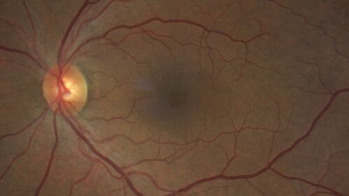 Pseudophakic cystoid macular edema (CME)
66 year old female 4 months following cataract surgery.  Never had very good vision after surgery.  On PF QID for one month.  VA 20/50 in both eyes.
