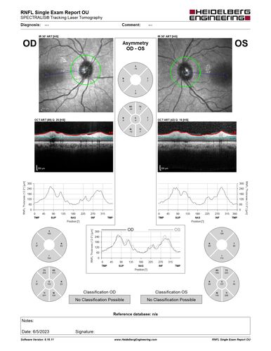 Pseudophakic cystoid macular edema (CME)
66 year old female 4 months following cataract surgery.  Never had very good vision after surgery.  On PF QID for one month.  VA 20/50 in both eyes.
