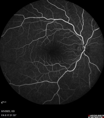 Pseudophakic cystoid macular edema (CME)
66 year old female 4 months following cataract surgery.  Never had very good vision after surgery.  On PF QID for one month.  VA 20/50 in both eyes.
