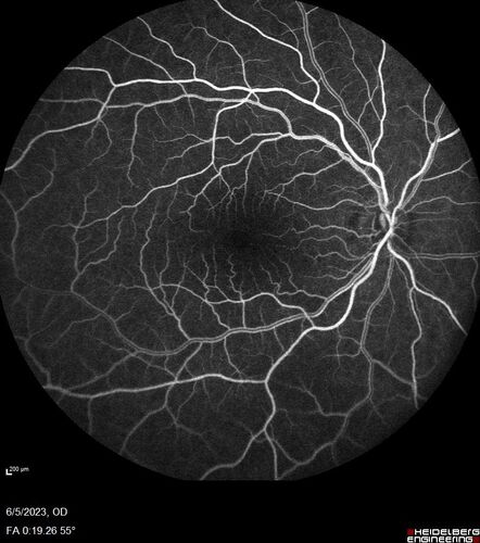 Pseudophakic cystoid macular edema (CME)
66 year old female 4 months following cataract surgery.  Never had very good vision after surgery.  On PF QID for one month.  VA 20/50 in both eyes.
