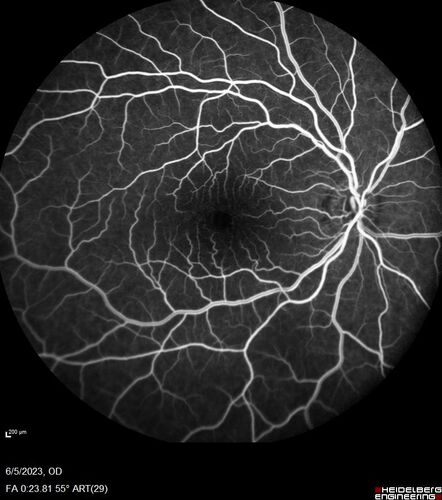 Pseudophakic cystoid macular edema (CME)
66 year old female 4 months following cataract surgery.  Never had very good vision after surgery.  On PF QID for one month.  VA 20/50 in both eyes.

