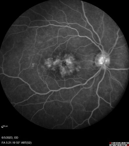 Pseudophakic cystoid macular edema (CME)
66 year old female 4 months following cataract surgery.  Never had very good vision after surgery.  On PF QID for one month.  VA 20/50 in both eyes.
