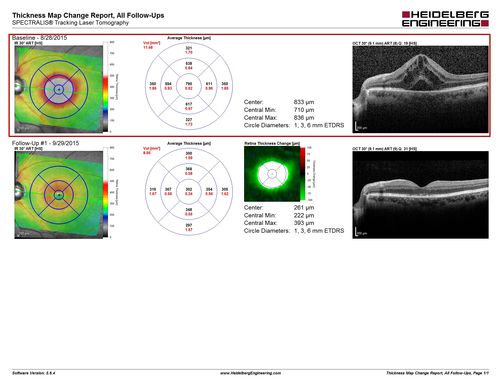 Cystoid macular edema 4 months following cataract surgery with serous retinal detachment
After Posterior sub tenon's kenalog vision improved within 1 month and IOP was fine
