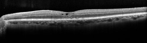 Cystoid macular edema 4 months following cataract surgery with serous retinal detachment
After Posterior sub tenon's kenalog vision improved within 1 month and IOP was fine
