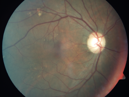 Cystoid macular edema 4 months following cataract surgery with serous retinal detachment
68 year old with 2 months of vision loss OS 20/100.  ECCE was 4 months ago.
