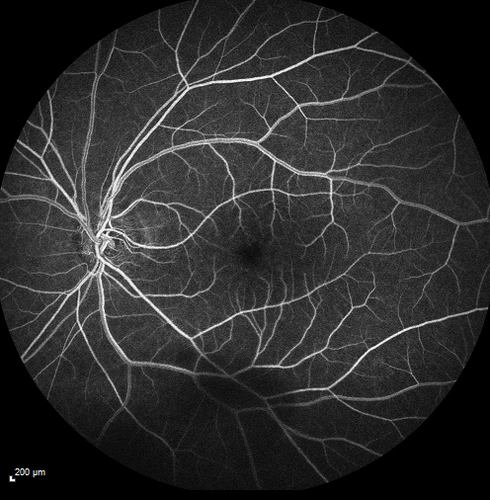 Pseudophakic CME with serous retinal detachment - FA shows leakage in both eyes
68 year old man with 2 months of vision loss.  FA shows CME, notice that the nerve also leaks.  This is typical for pseudophakic inflammatory cystoid macular edema
