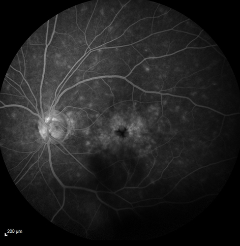 Pseudophakic CME with serous retinal detachment - FA shows leakage in both eyes
68 year old man with 2 months of vision loss.  FA shows CME, notice that the nerve also leaks.  This is typical for pseudophakic inflammatory cystoid macular edema
