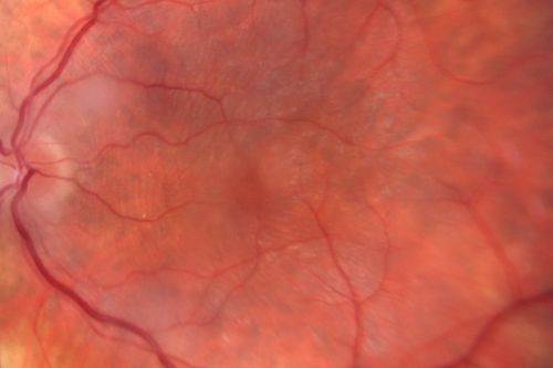 Chronic Pseudophakic Cystoid Macular Edema - Haptic Migrated into Anterior Chamber Through Peripheral Iridotomy
57-year-old man with congenital nystagmus.  He had cataract surgery done 30 years ago and has decreased vision left eye for 6 months. OD is 20/50, OS is 20/100
