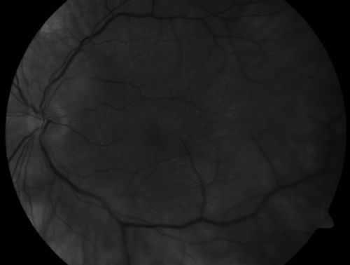Chronic Pseudophakic Cystoid Macular Edema - Haptic Migrated into Anterior Chamber Through Peripheral Iridotomy
57-year-old man with congenital nystagmus.  He had cataract surgery done 30 years ago and has decreased vision left eye for 6 months. OD is 20/50, OS is 20/100
