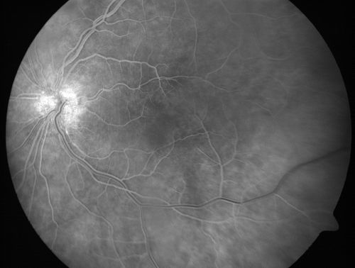 Chronic Pseudophakic Cystoid Macular Edema - Haptic Migrated into Anterior Chamber Through Peripheral Iridotomy
57-year-old man with congenital nystagmus.  He had cataract surgery done 30 years ago and has decreased vision left eye for 6 months. OD is 20/50, OS is 20/100
