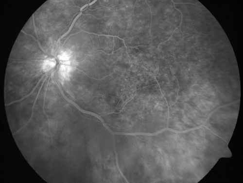 Chronic Pseudophakic Cystoid Macular Edema - Haptic Migrated into Anterior Chamber Through Peripheral Iridotomy
57-year-old man with congenital nystagmus.  He had cataract surgery done 30 years ago and has decreased vision left eye for 6 months. OD is 20/50, OS is 20/100
