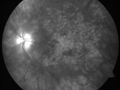 Chronic Pseudophakic Cystoid Macular Edema - Haptic Migrated into Anterior Chamber Through Peripheral Iridotomy
57-year-old man with congenital nystagmus.  He had cataract surgery done 30 years ago and has decreased vision left eye for 6 months. OD is 20/50, OS is 20/100

