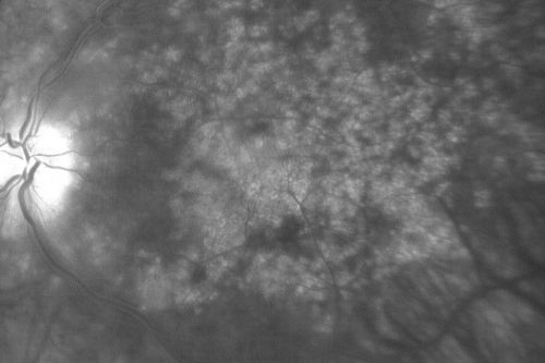 Chronic Pseudophakic Cystoid Macular Edema - Haptic Migrated into Anterior Chamber Through Peripheral Iridotomy
57-year-old man with congenital nystagmus.  He had cataract surgery done 30 years ago and has decreased vision left eye for 6 months. OD is 20/50, OS is 20/100
