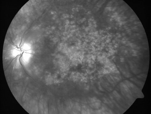 Chronic Pseudophakic Cystoid Macular Edema - Haptic Migrated into Anterior Chamber Through Peripheral Iridotomy
57-year-old man with congenital nystagmus.  He had cataract surgery done 30 years ago and has decreased vision left eye for 6 months. OD is 20/50, OS is 20/100
