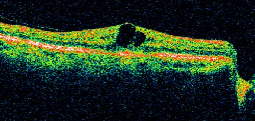 Idiopathic Cystoid Macular Edema - CME - Responded to Subtenons Kenalog - Pre Treatment Line Scan ShowingLarge  Foveal Cysts
49-year-old man had a flu two weeks ago the right eye has been throbbing and his vision in the right eye has been foggy.  OD 20/80, OS 20/40.   IOP:  14 OU.  

Mots-clés: cme;cystoid macular edema;steroids;idiopathic