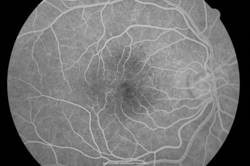 Idiopathic Cystoid Macular Edema - CME - Responded to Subtenons Kenalog - Early Fluorescein Angiogram Showing Dilated Capillaries
49-year-old man had a flu two weeks ago the right eye has been throbbing and his vision in the right eye has been foggy.  OD 20/80, OS 20/40.   IOP:  14 OU.  

Keywords: cme;cystoid macular edema;steroids;idiopathic