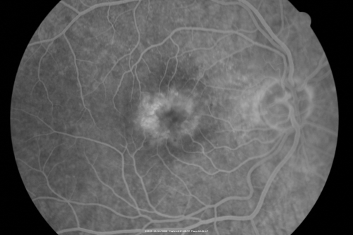 Idiopathic Cystoid Macular Edema - Mid Phase Fluorescein Angiogram Showing Leakage of Dye into Center of Macula
49-year-old man had a flu two weeks ago the right eye has been throbbing and his vision in the right eye has been foggy.  OD 20/80, OS 20/40.   IOP:  14 OU.  

Keywords: cme;cystoid macular edema;steroids;idiopathic