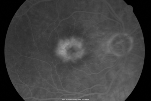 Idiopathic Cystoid Macular Edema - CME - Responded to Subtenons Kenalog - Fluorescein Angiogram - Leakage of White Dye Into Center of Macula
49-year-old man had a flu two weeks ago the right eye has been throbbing and his vision in the right eye has been foggy.  OD 20/80, OS 20/40.   IOP:  14 OU.  

Keywords: cme;cystoid macular edema;steroids;idiopathic