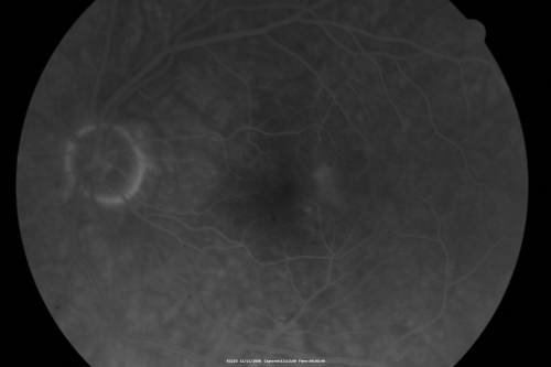 Idiopathic Cystoid Macular Edema - CME - Responded to Subtenons Kenalog - Fellow (uninvolved) Eye Nearly Normal Dark Center FA
49-year-old man had a flu two weeks ago the right eye has been throbbing and his vision in the right eye has been foggy.  OD 20/80, OS 20/40.   IOP:  14 OU.  

Keywords: cme;cystoid macular edema;steroids;idiopathic