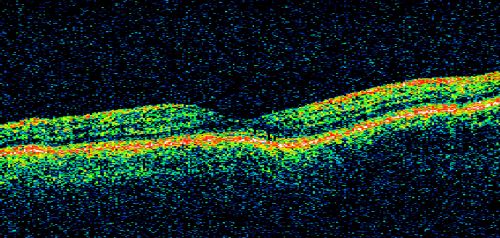 Cystoid Macular Edema - Xalatan - ECCE was done 20 years previously - 1 year later 20/40 Vision
Xalatan stopped and a brief course of topical anti-inflammatory drops was prescribed.  One year later vision is back to normal
