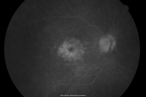 Cystoid Macular Edema - Xalatan - ECCE was done 20 years previously
71 Year old woman who noticed about a month ago the central vision in the right eye fogged up.  OD 20/200	POSSIBLE XALATAN INDUCED CYSTOID MACULAR EDEMA 
Keywords: cme;xalatan