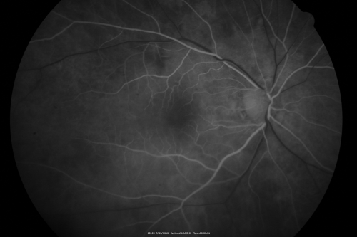 Cystoid Macular Edema - Xalatan - ECCE was done 20 years previously
71 Year old woman who noticed about a month ago the central vision in the right eye fogged up.  OD 20/200	POSSIBLE XALATAN INDUCED CYSTOID MACULAR EDEMA 
Keywords: cme;xalatan