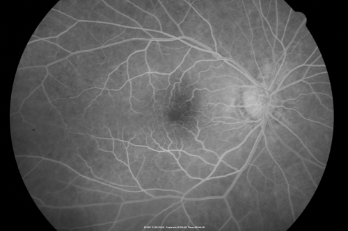 Cystoid Macular Edema - Xalatan - ECCE was done 20 years previously
71 Year old woman who noticed about a month ago the central vision in the right eye fogged up.  OD 20/200	POSSIBLE XALATAN INDUCED CYSTOID MACULAR EDEMA 
Keywords: cme;xalatan