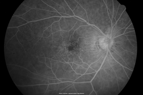 Cystoid Macular Edema - Xalatan - ECCE was done 20 years previously
71 Year old woman who noticed about a month ago the central vision in the right eye fogged up.  OD 20/200	POSSIBLE XALATAN INDUCED CYSTOID MACULAR EDEMA 
Keywords: cme;xalatan