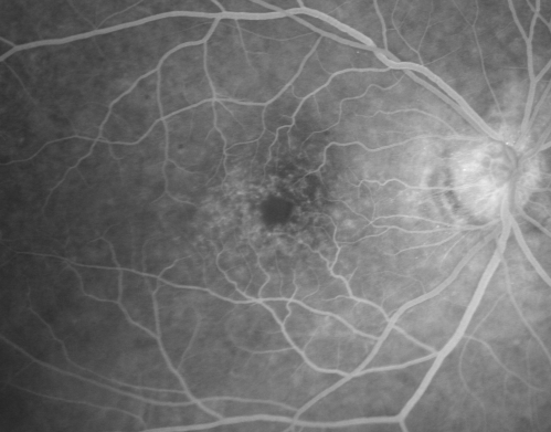 Cystoid Macular Edema - Xalatan - ECCE was done 20 years previously
71 Year old woman who noticed about a month ago the central vision in the right eye fogged up.  OD 20/200	POSSIBLE XALATAN INDUCED CYSTOID MACULAR EDEMA 
Keywords: cme;xalatan