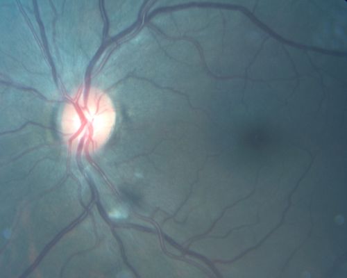 Cytomegalovirus Retinitis - Partially Treated and AIDS retinopathy
44-year-old man a month agoe was diagnosed with HIV and he had pneumonia.  He has had blurred vision for about a month, more in the left eye than the right eye. He has not yet seen anyone to start anti-AIDS therapy.  He was given a medical doctor's name for a follow-up visit.  He thinks his CD4 count is somewhere in the low 100s.   Vision OU is 20/30
