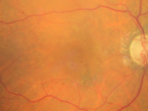 Non-exudative wet AMD right eye (treatment naive quiescent)
82 year old man.  ICG shows CNVM in the right eye.  This stayed quiet for 3 years and then started leaking and responded well to Avastin.
