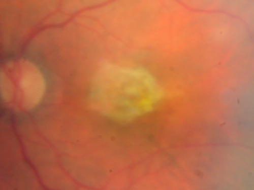 Non-exudative wet AMD right eye (treatment naive quiescent)
82 year old man.  ICG shows CNVM in the right eye.  This stayed quiet for 3 years and then started leaking and responded well to Avastin.
