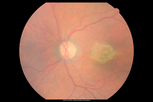 Non-exudative wet AMD right eye (treatment naive quiescent)
82 year old man.  ICG shows CNVM in the right eye.  This stayed quiet for 3 years and then started leaking and responded well to Avastin.
