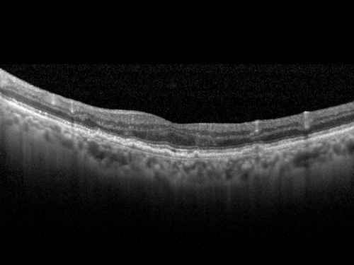 Non-exudative wet AMD right eye (treatment naive quiescent)
82 year old man.  ICG shows CNVM in the right eye.  This stayed quiet for 3 years and then started leaking and responded well to Avastin.
