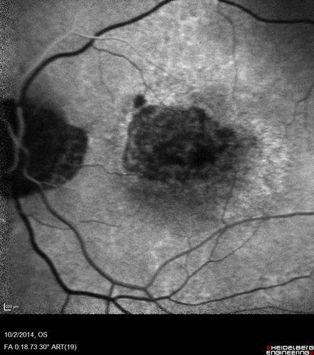Non-exudative wet AMD right eye (treatment naive quiescent)
82 year old man.  ICG shows CNVM in the right eye.  This stayed quiet for 3 years and then started leaking and responded well to Avastin.
