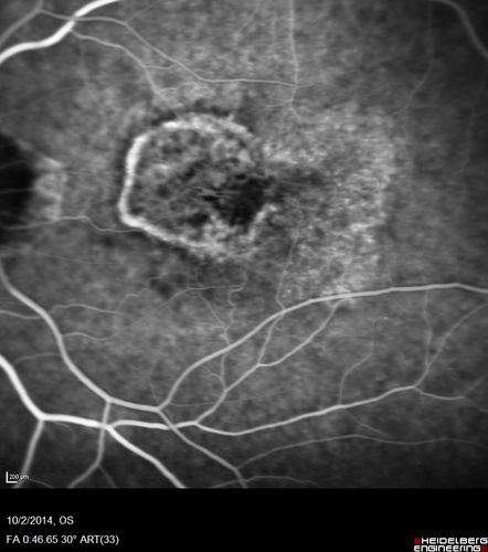 Non-exudative wet AMD right eye (treatment naive quiescent)
82 year old man.  ICG shows CNVM in the right eye.  This stayed quiet for 3 years and then started leaking and responded well to Avastin.
