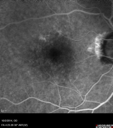 Non-exudative wet AMD right eye (treatment naive quiescent)
82 year old man.  ICG shows CNVM in the right eye.  This stayed quiet for 3 years and then started leaking and responded well to Avastin.
